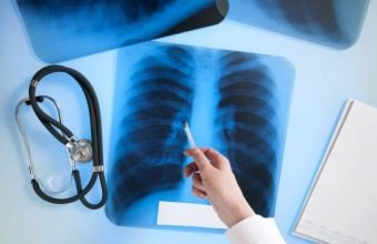 Azərbaycanda vərəmə yoluxan uşaqların sayı açıqlanıb