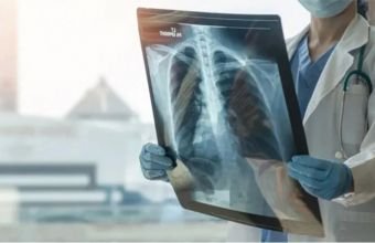 Son 10 ildə Azərbaycanda vərəmlə xəstələnmə halları iki dəfəyədək azalıb