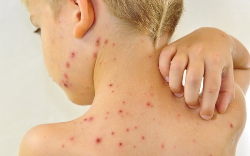 Qızılca və suçiçəyi ilə bağlı epidemioloji vəziyyət açıqlandı