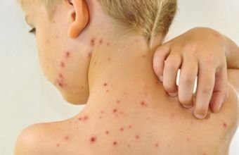 Qızılca və suçiçəyi ilə bağlı epidemioloji vəziyyət açıqlandı
